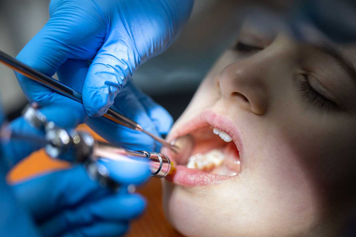 Alveolitas ir kitos komplikacijos po danties rovimo: kada skausmas nebėra normalus? 5 Alveolitas po danties rovimo – odontologas apžiūri danties lizdą po ekstrakcijos