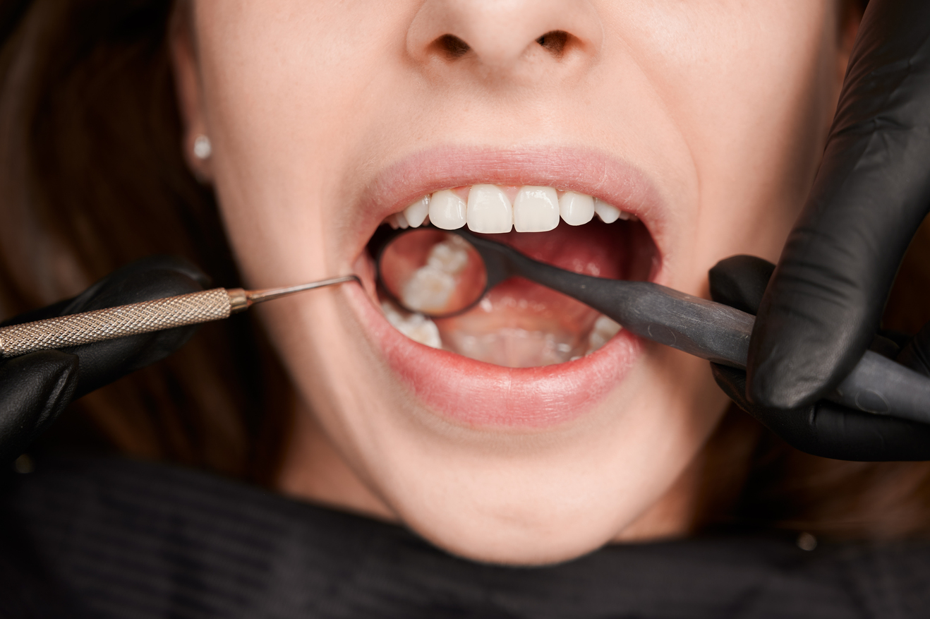 Alveolitas ir kitos komplikacijos po danties rovimo: kada skausmas nebėra normalus? 2 Alveolito gydymas – odontologas įvertina danties lizdo būklę odontologo kabinete